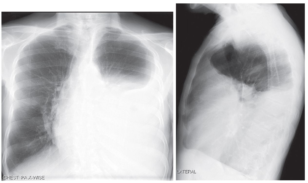 pleural effusion x ray lateral