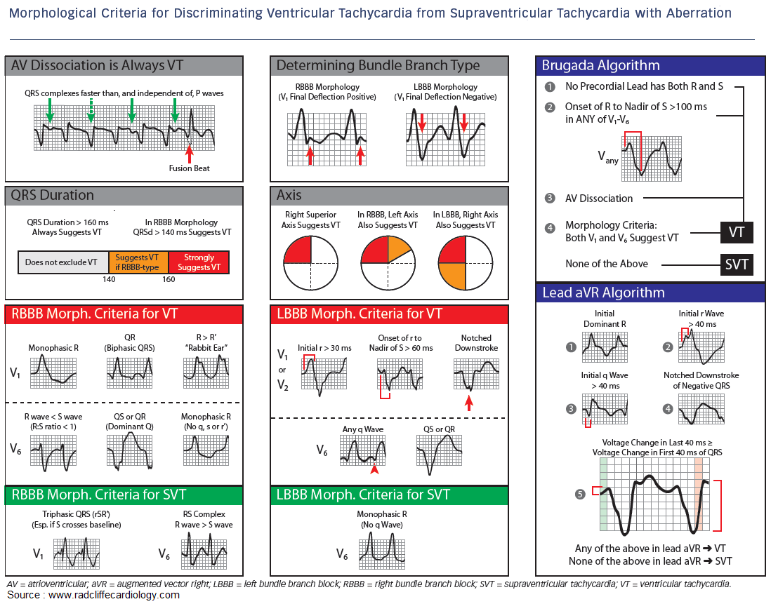 V tach shop vs supraventricular tachycardia