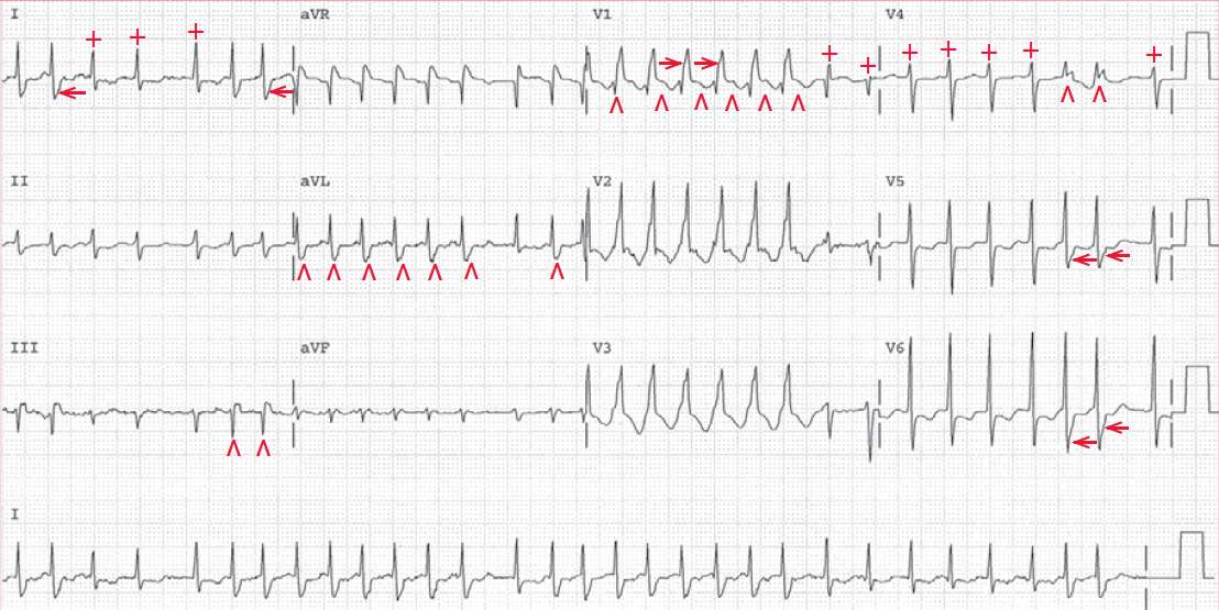 ECG Case 150: Atrial Fibrillation With Rapid Ventricular, 42% OFF