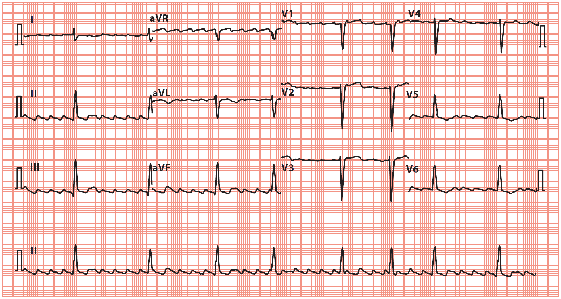 ventricular flutter