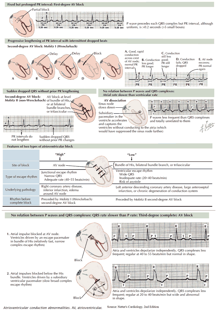 Overview of atrioventricular (AV) blocks – ECG & ECHO