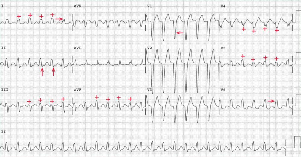 Av Nodal Reentrant Tachycardia Ecg