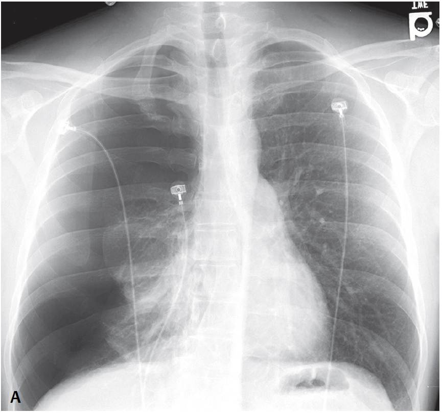 apical pneumothorax chest x ray