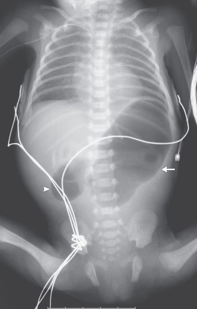 Duodenal Atresia X Ray