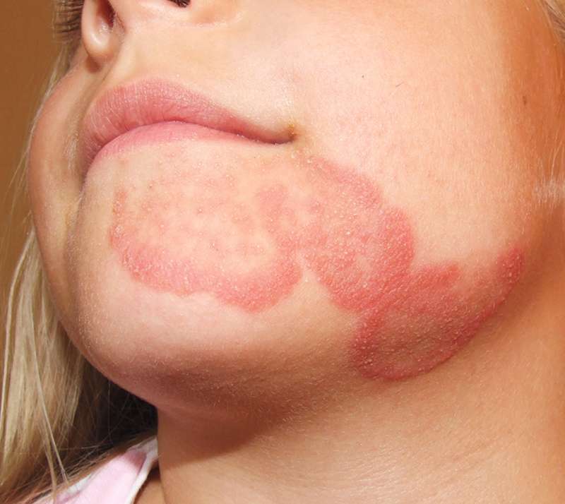 Search Results: Chin, Rash or multiple lesions