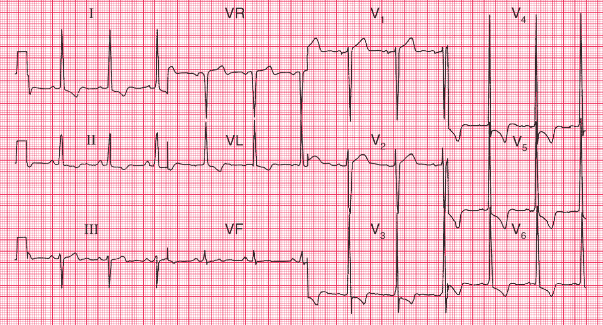 Left Ventricular Hypertrophy (LVH): Causes, Symptoms and Treatment