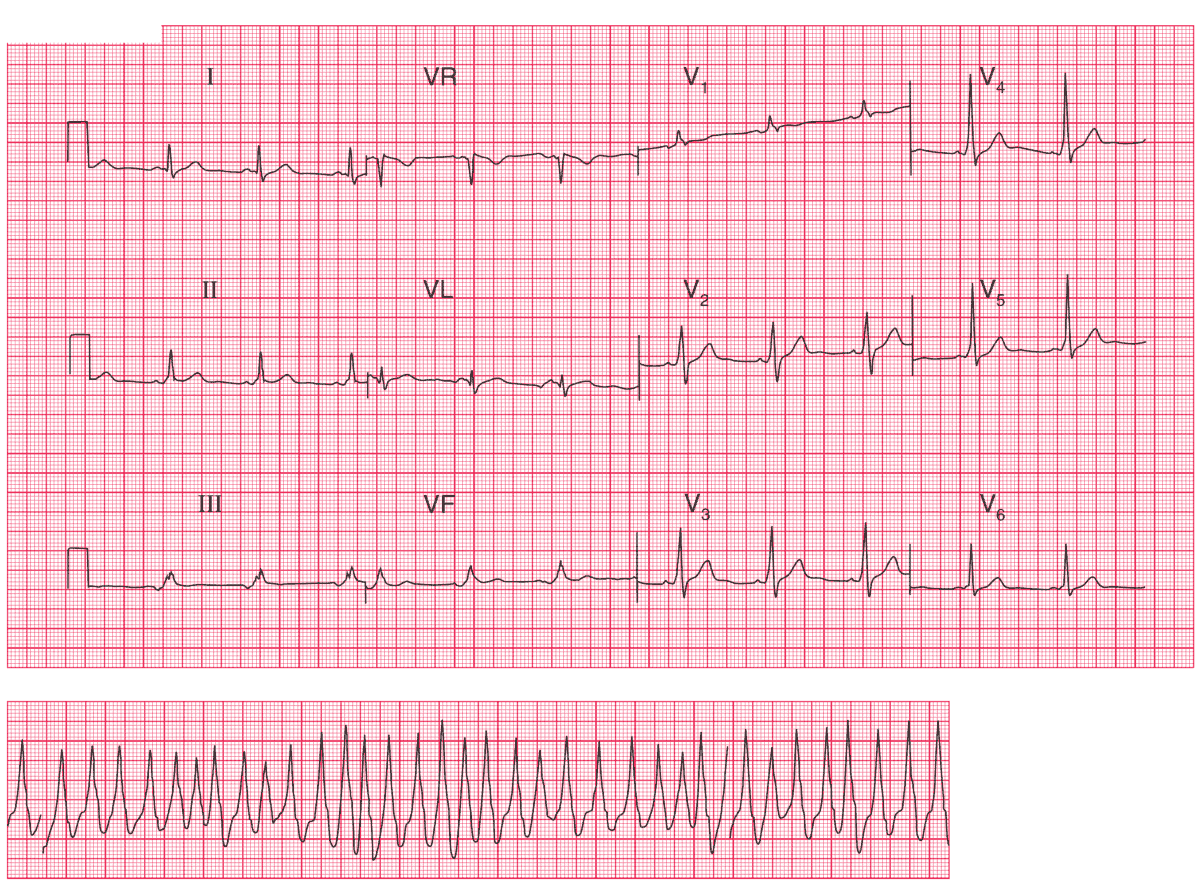 paroxysmal atrial fibrillation