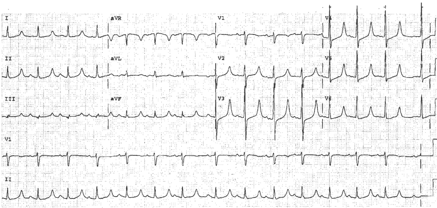 hyperkalemia ekg