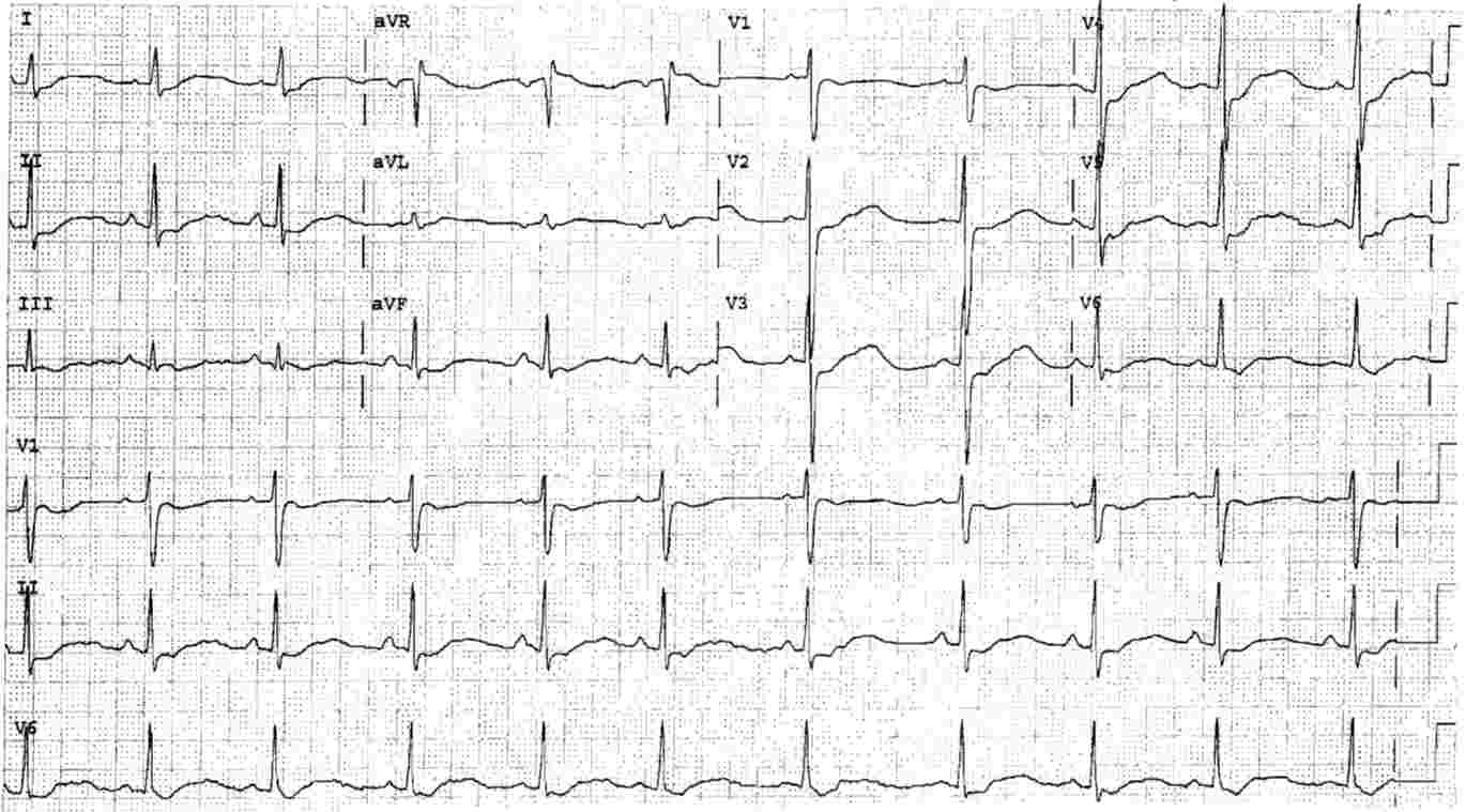 Hypokalemia ECG Changes [With Examples] Manual Of Medicine, 42% OFF