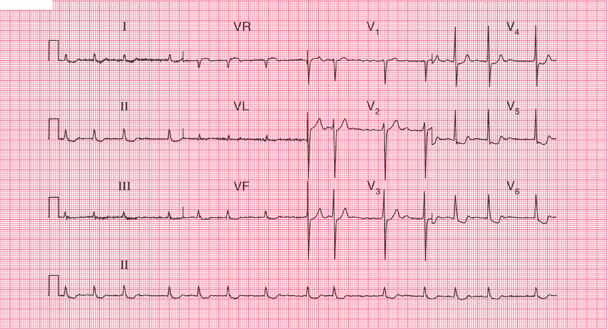 digitalis ecg