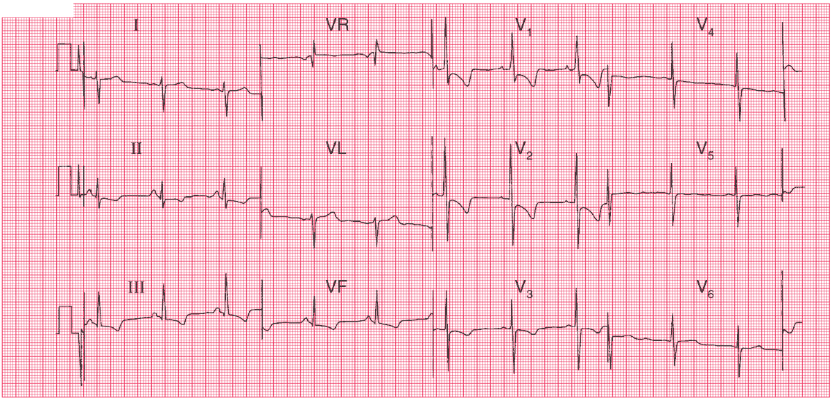 CCU Right Ventricular Hypertrophy (RVH) Facebook, 54% OFF