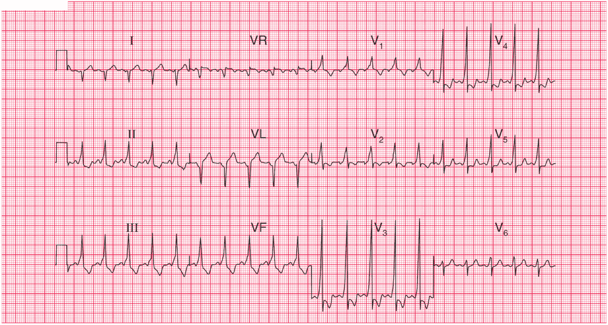 Wolff-Parkinson-White Syndrome