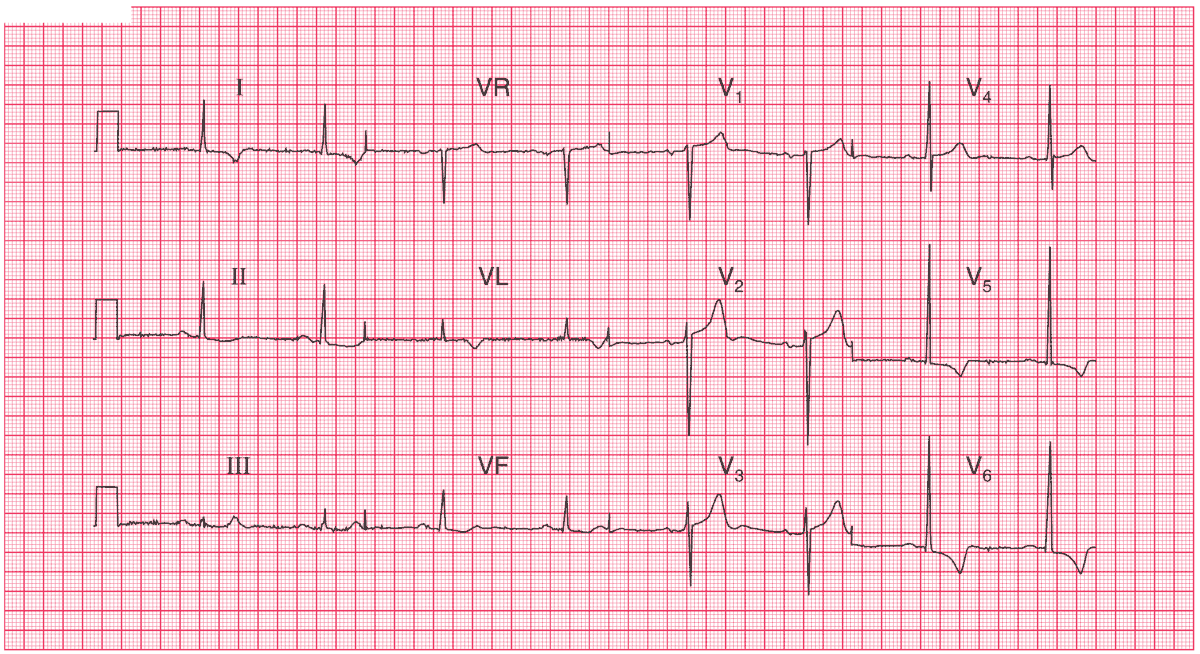 Left Ventricular Hypertrophy Electrocardiogram Wikidoc, 53% OFF