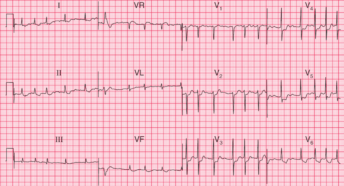 afib with rvr treatment