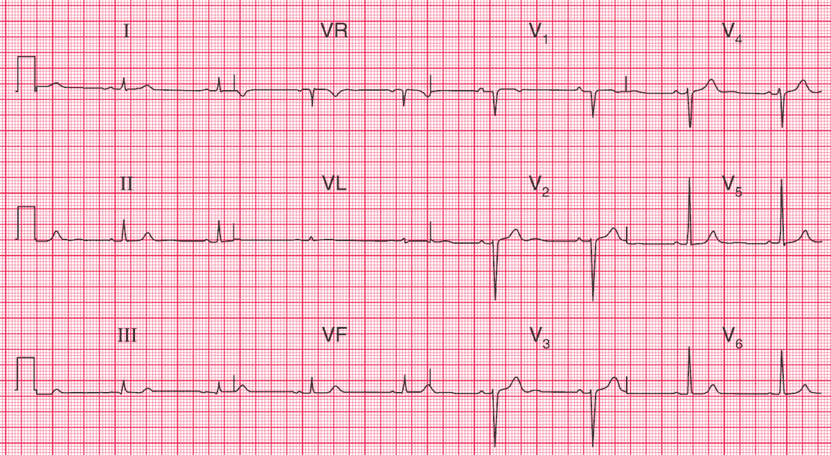 anterior myocardial infarction ecg