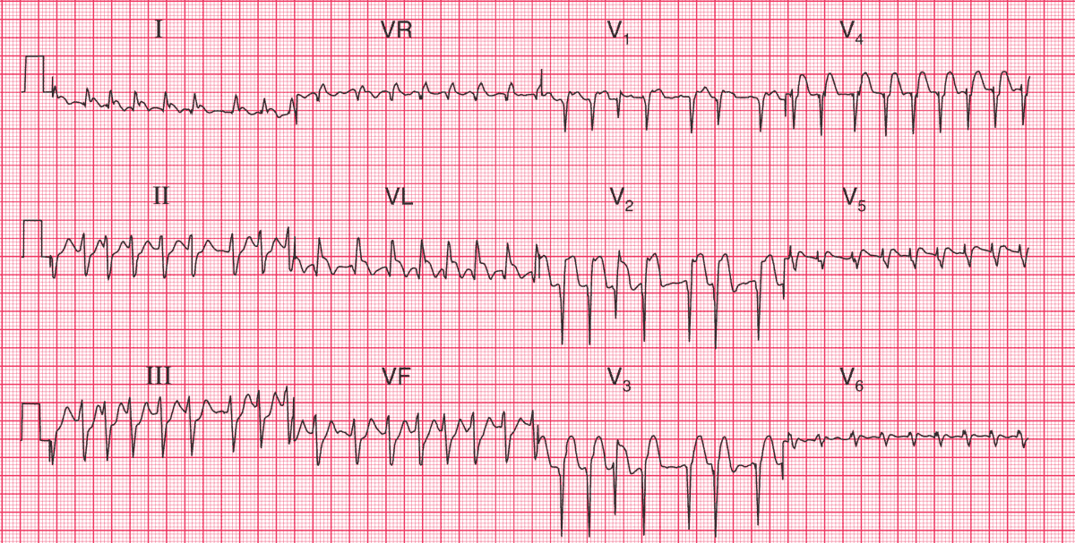 afib with rvr treatment