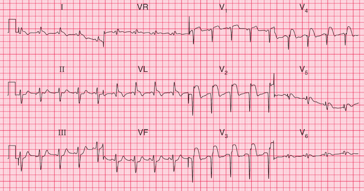 ECG Case 82: Acute Antero-Lateral STEMI And Left Anterior, 41% OFF