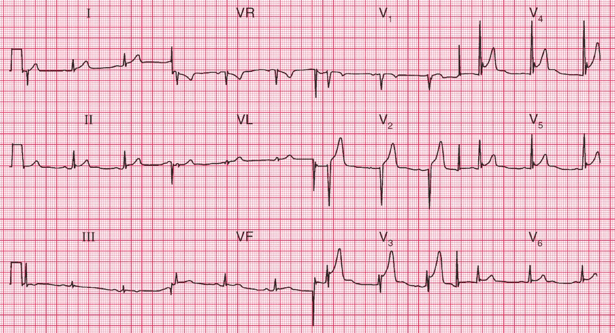 Early Repolarization