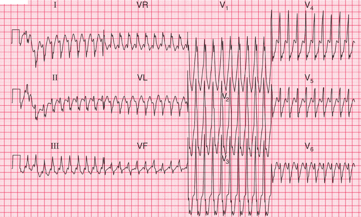 Pre-excitation, Atrioventricular Reentrant (Reentry), 44% OFF