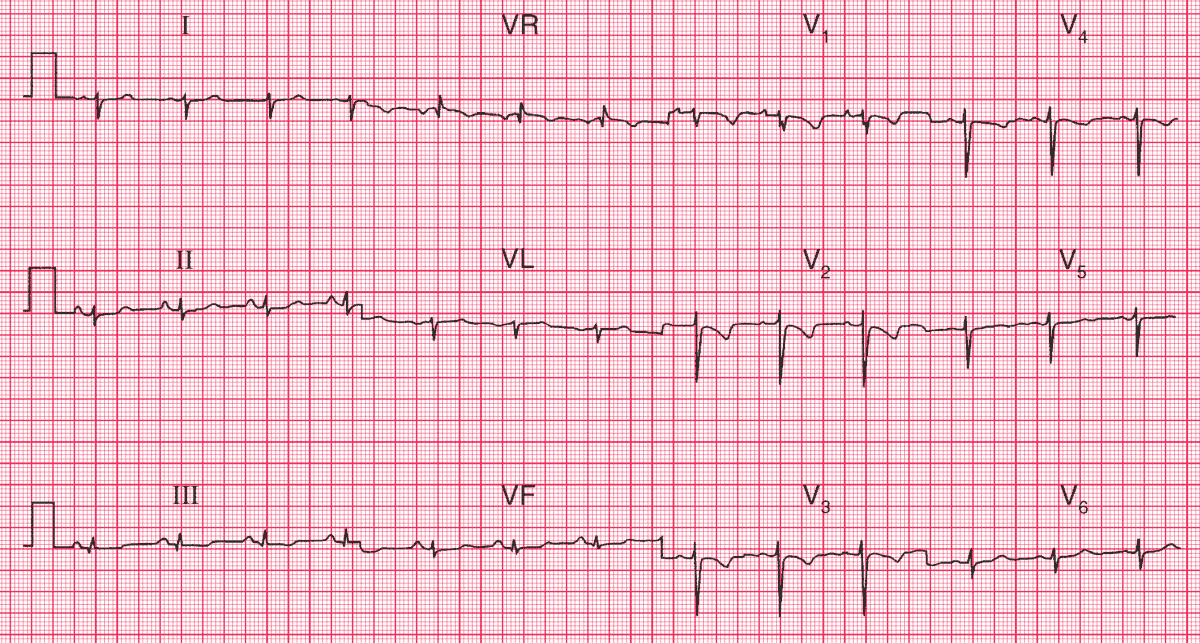 Right ventricular strain