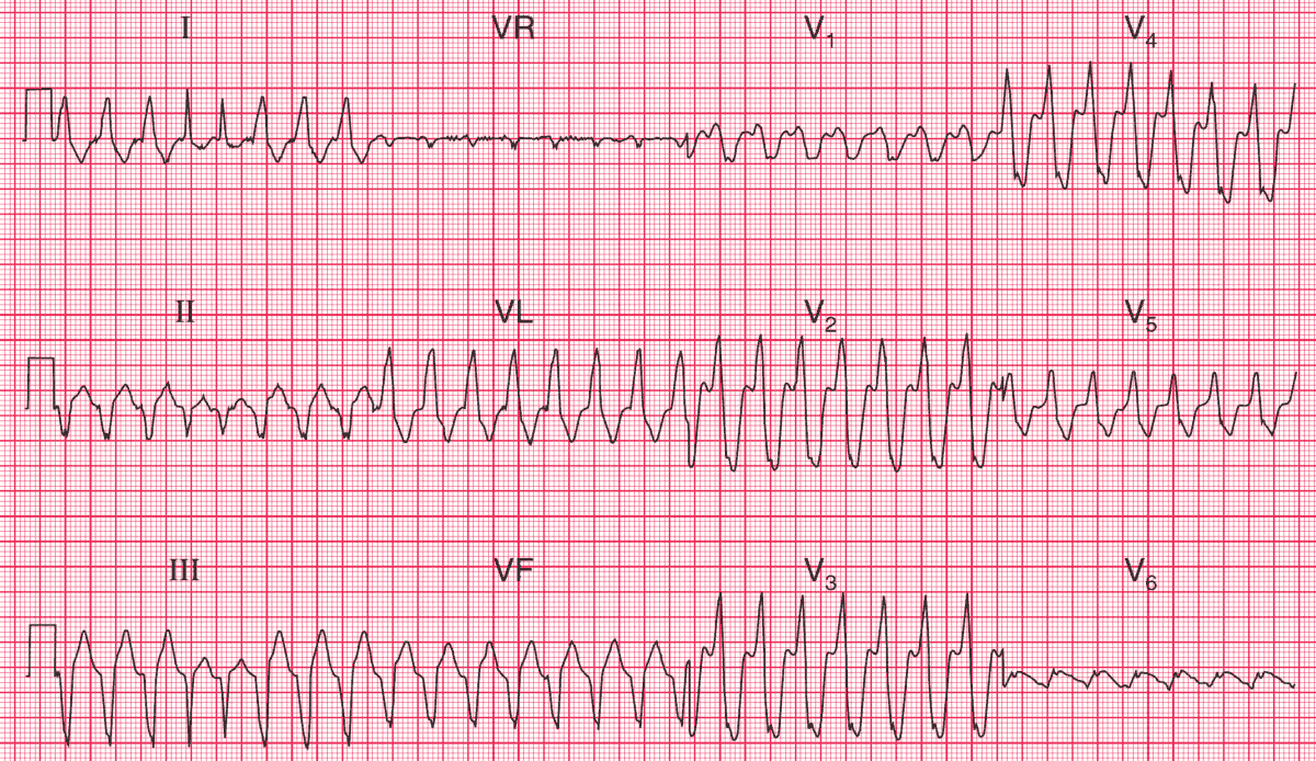 ventricular tachycardia ecg