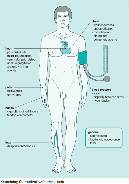 chest pain location chart