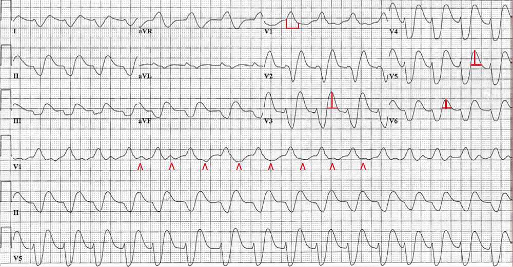 Sine Wave Ecg Pattern