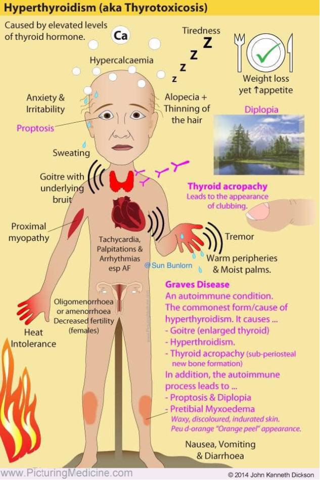 Image result for Managing Graves Disease Symptoms infographics