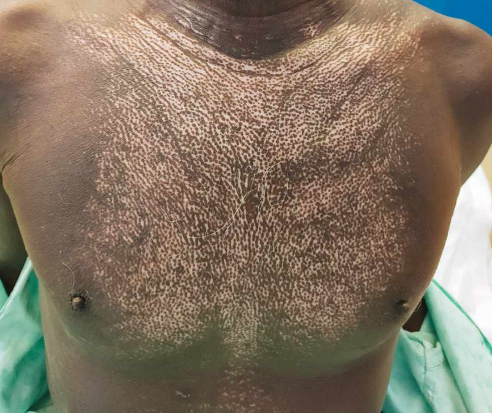 hypopigmentation