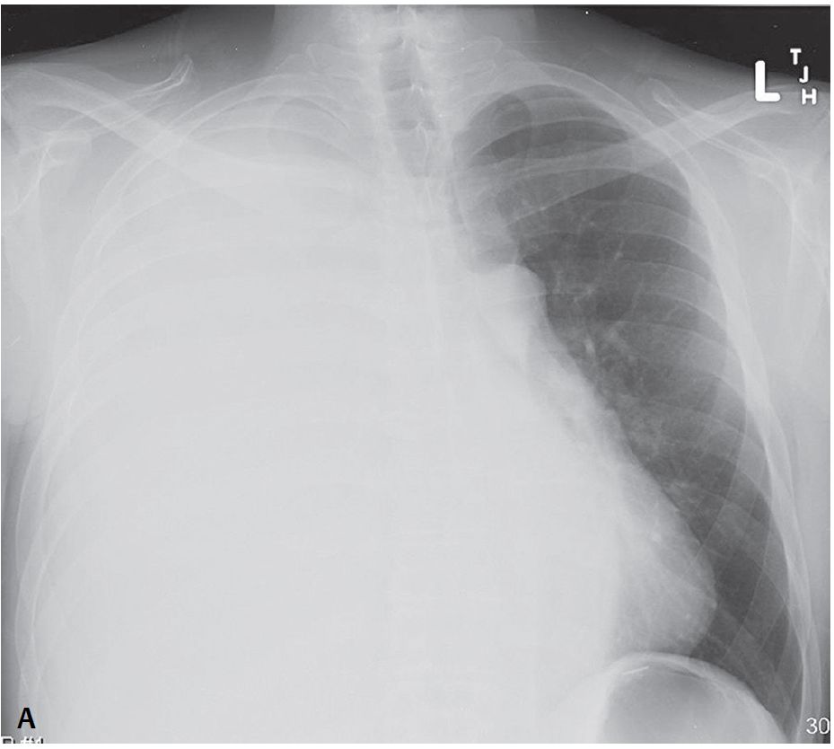 chest xray pleural effusion