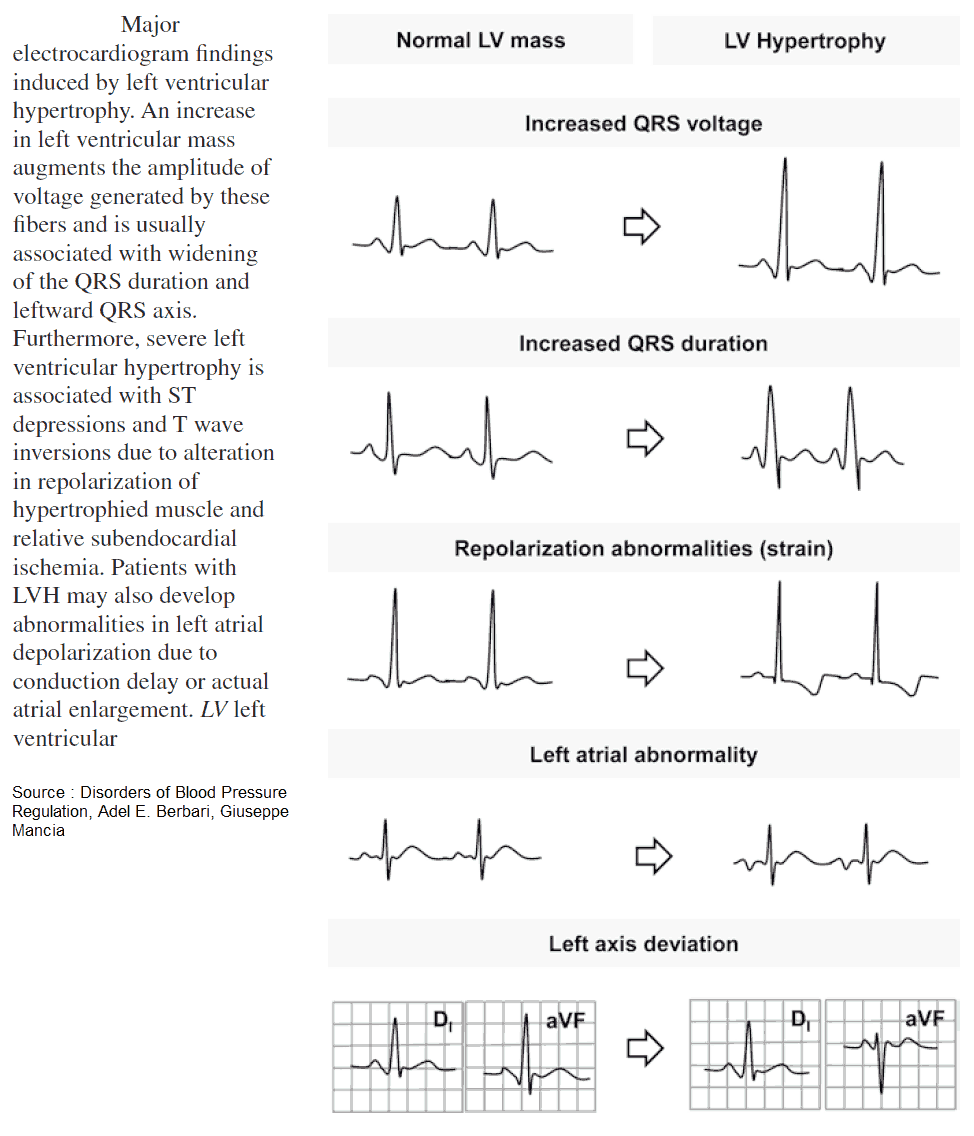 What is Left Ventricular Hypertrophy (LVH)?