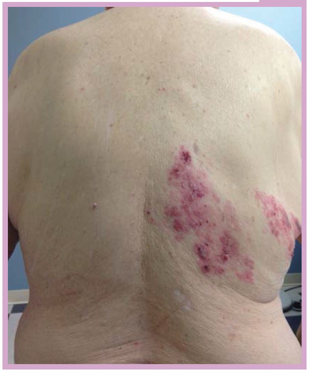 Extremely pruritic rash on the back and chest - Clinical Advisor