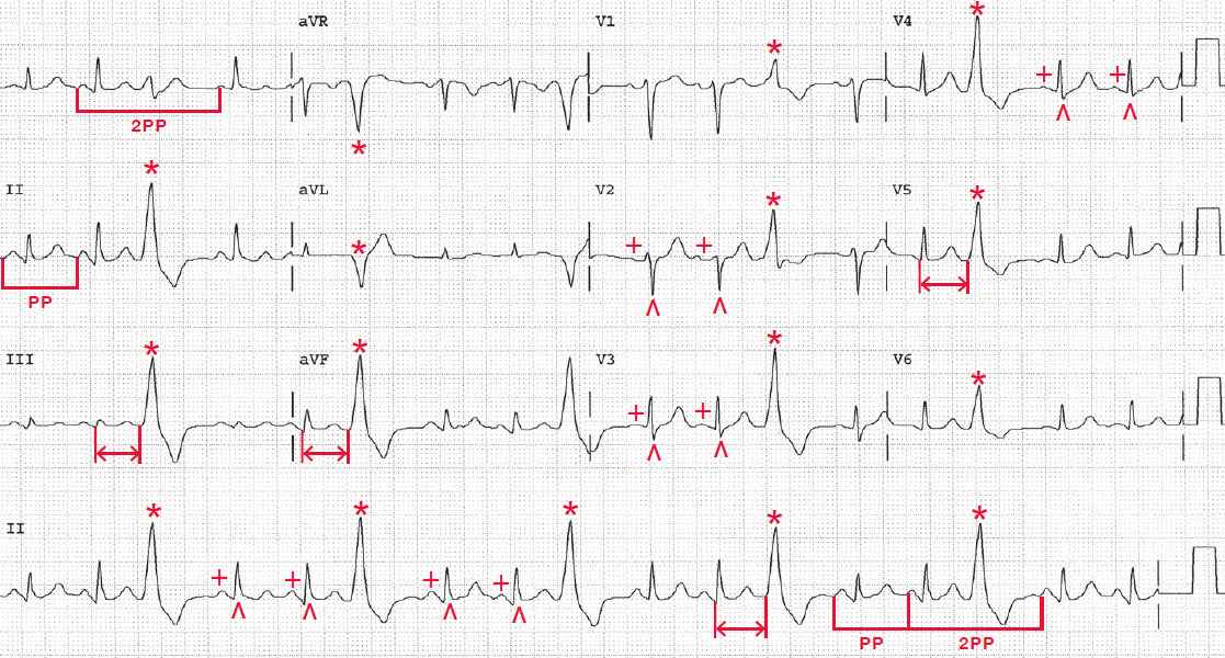 Pvc With Normal Sinus Rhythm Outlet | vivatumusica.com