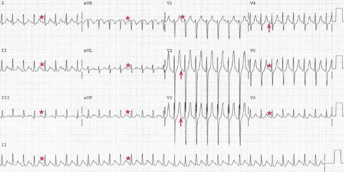 sinus tachycardia