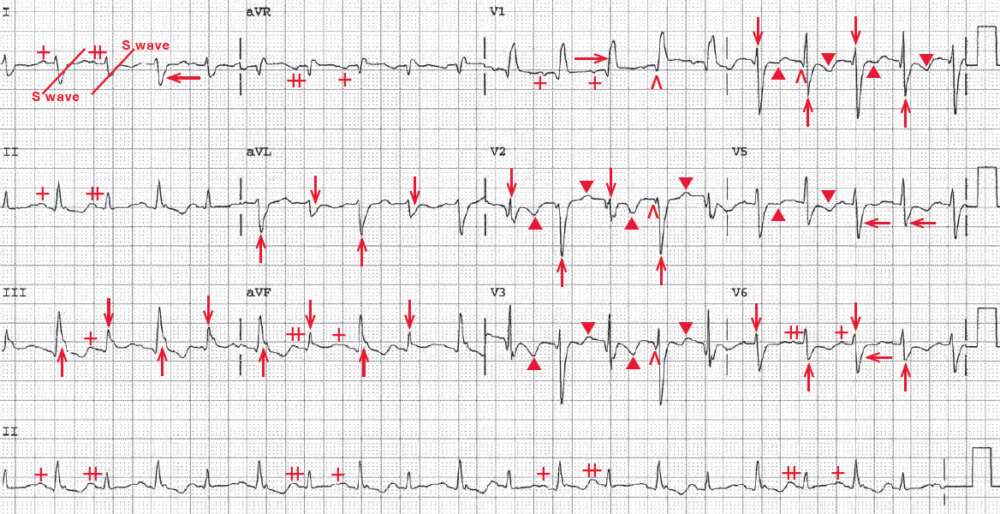 Alternans