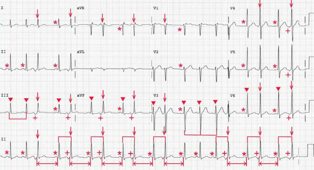 ECG Case 119 Sinus Tachycardia with Frequent Premature Atrial