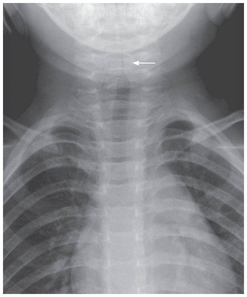 Steeple sign (trachea), Radiology Reference Article