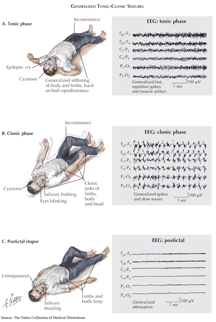 Tonic Seizure