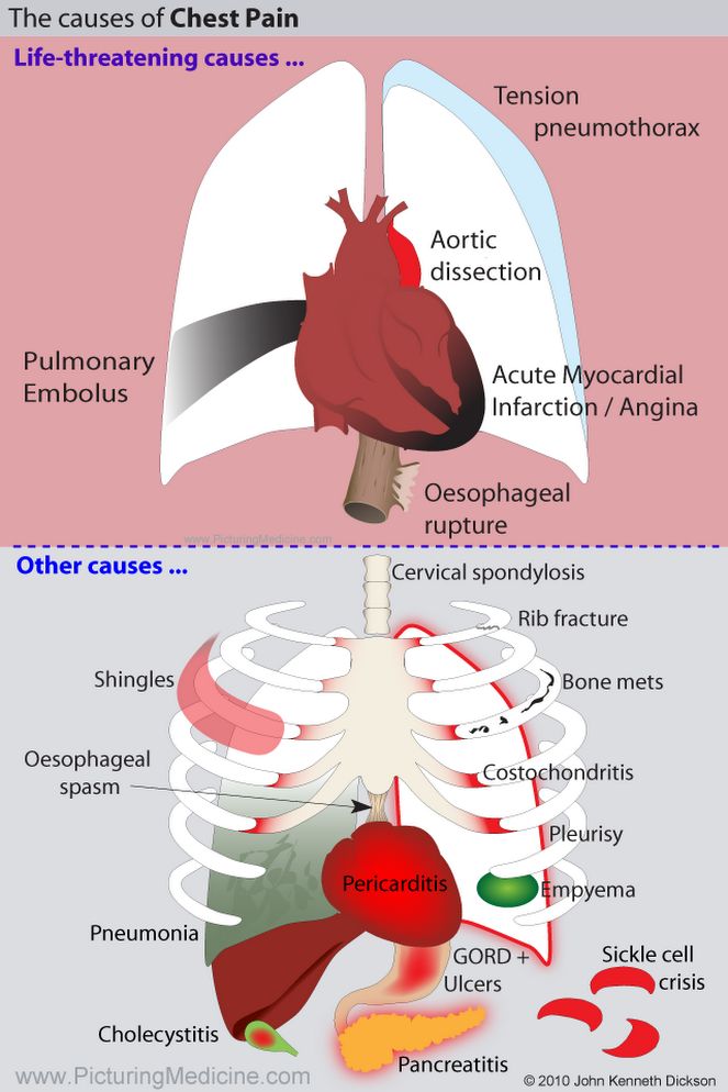 Chest Pain: Causes, Approach and Evaluation - Manual of Medicine