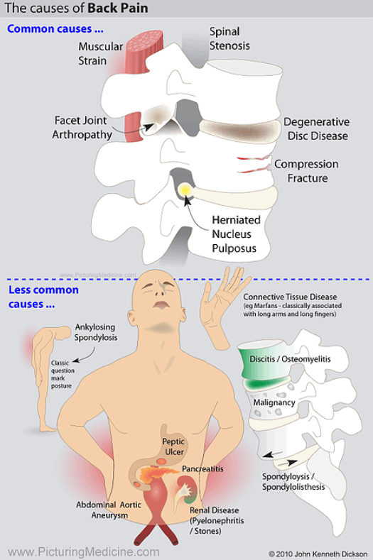 Red Flag Signs and Symptoms of Back Pain Infographic