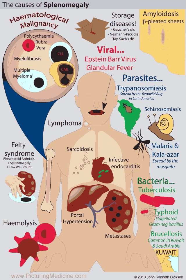 Causes of Spleen Pain