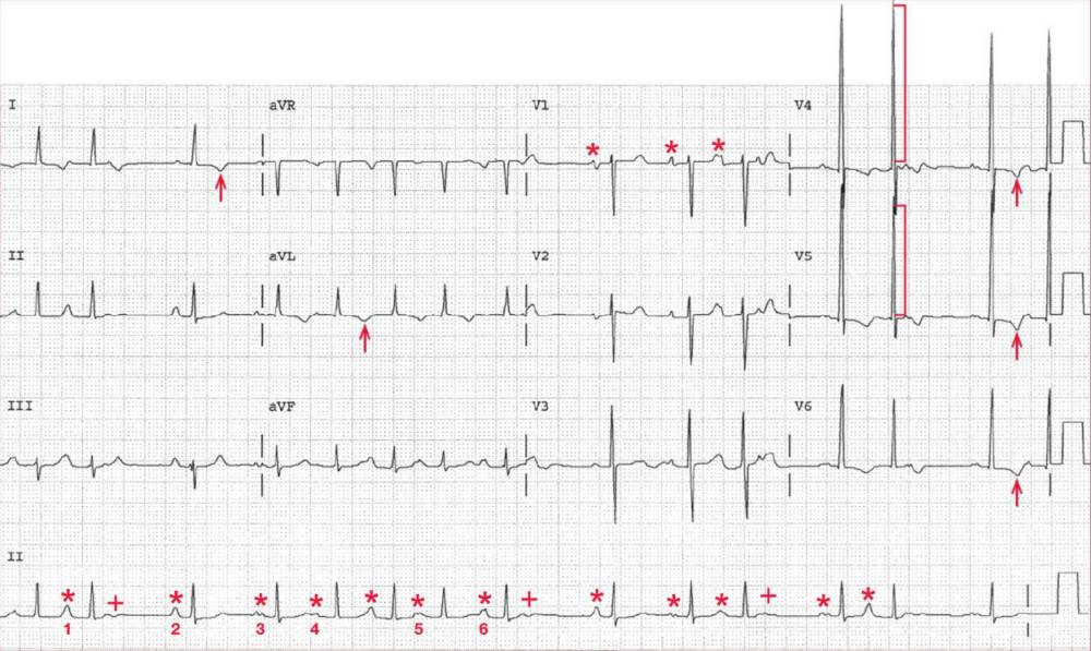 wandering atrial pacemaker