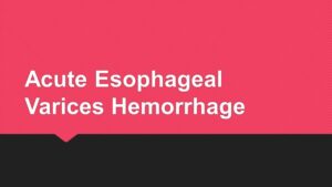 Read more about the article Acute Esophageal Varices Hemorrhage