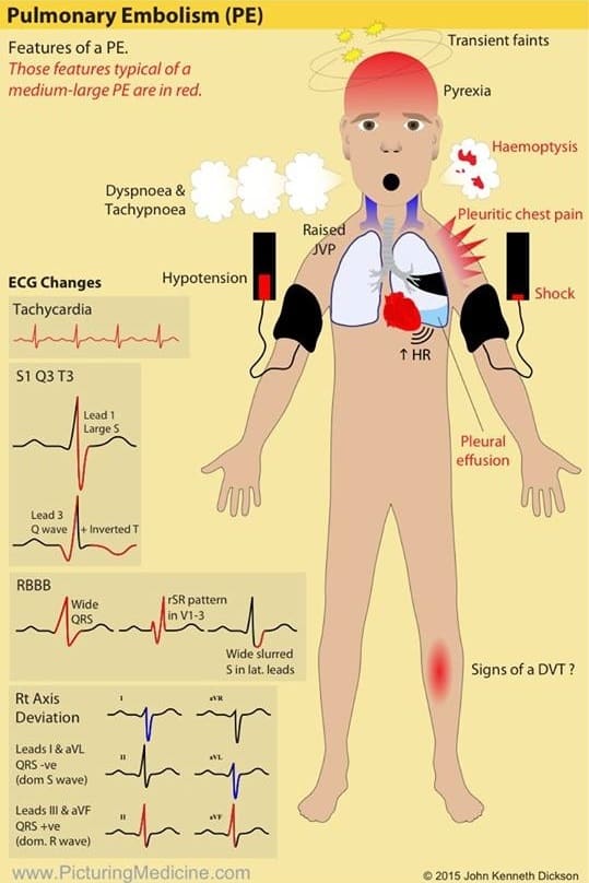Symptoms, Signs and ECG Changes in Pulmonary Thromboembolism