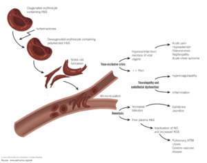 Read more about the article Vaso-Occlusive Episode (VOE) in Sickle Cell Disease