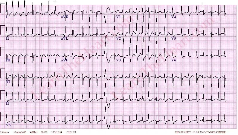 Management Of Atrial Fibrillation (af) With Rapid Ventricular Response 