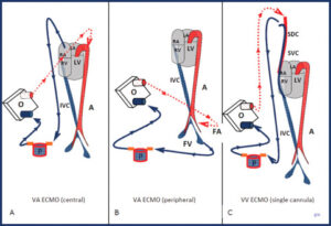 Read more about the article Extracorporeal membrane oxygenation (ECMO)