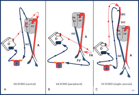 Read more about the article Extracorporeal membrane oxygenation (ECMO)