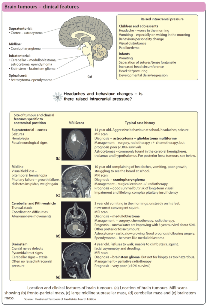 Brain tumours – clinical features