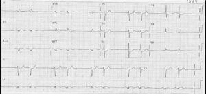 Read more about the article ECG Case 3